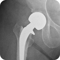 Hip X-ray