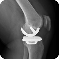 Knee X-ray